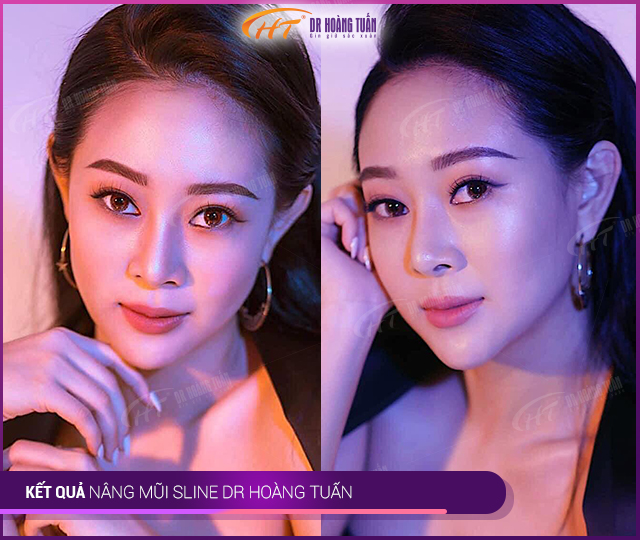 kết quả nâng mũi s line